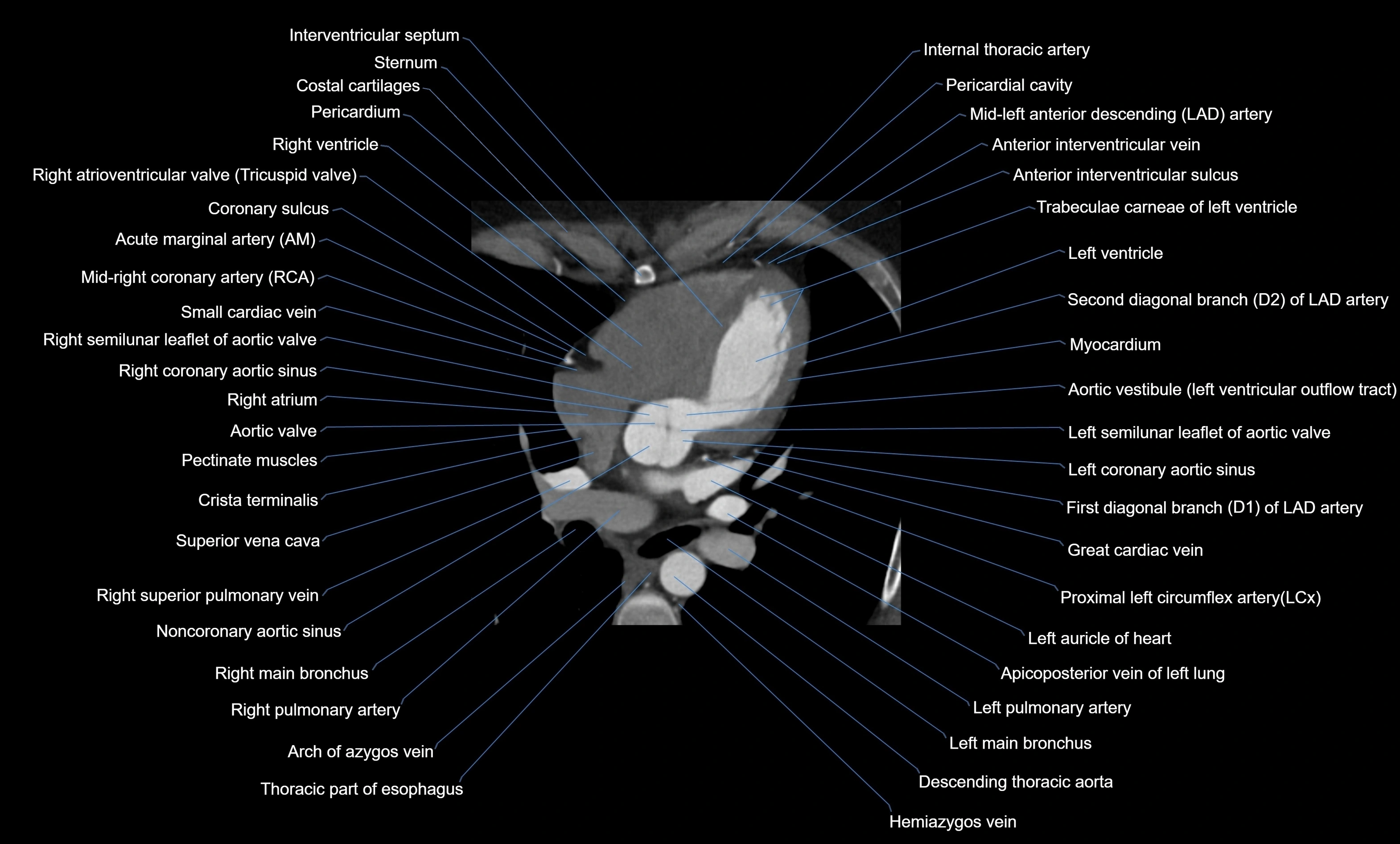 CT heart (coronary angiogram) four chamber view  cross sectional anatomy labelled radiology image -00023.webp